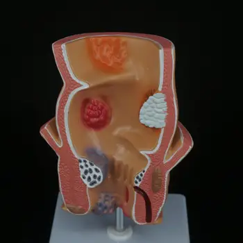 Модел на патологичните лезии на ректума човек от PVC Хемороиди Ануса Медицинско Обучение на Ректума Обучение